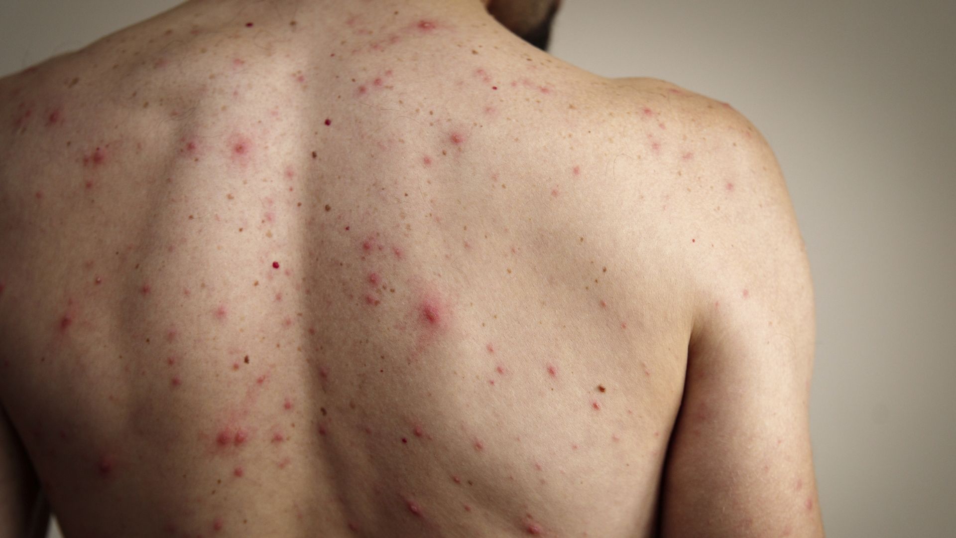 Argentina confirma nuevo caso importado de sarampión y activa alerta epidemiológica